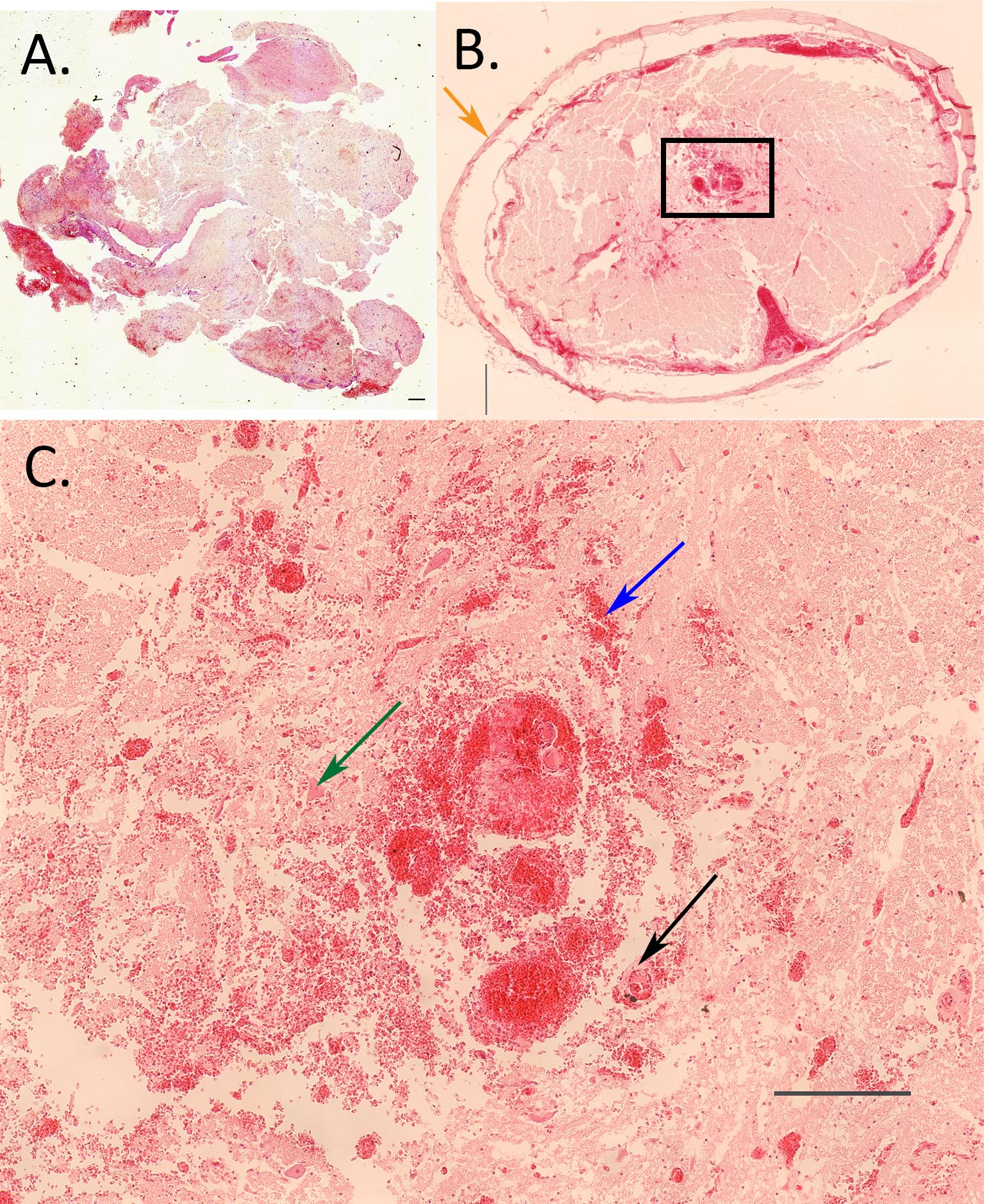 Histological image of  spinal cord with ascending-descending myelomalacia