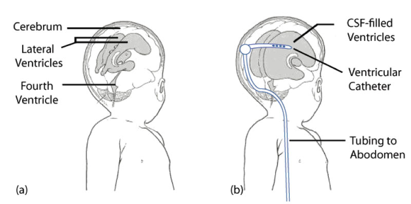 Hydrocephalus Shunt Placement 5440