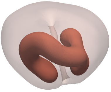 Prostate cancer growth simulation